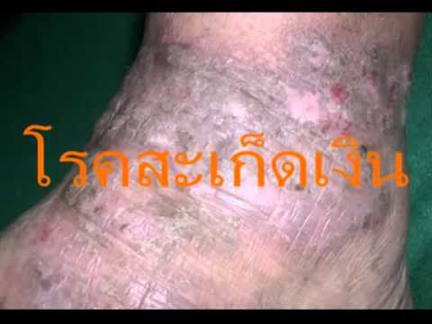 โรคสะเก็ดเงินแชมพูรักษาสี ร้องไห้คิดเห็นครีมกลาก