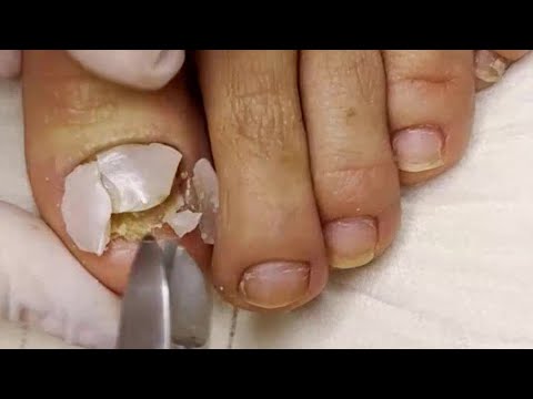 Cum să vindeci ciuperca de pe unghii și picioare