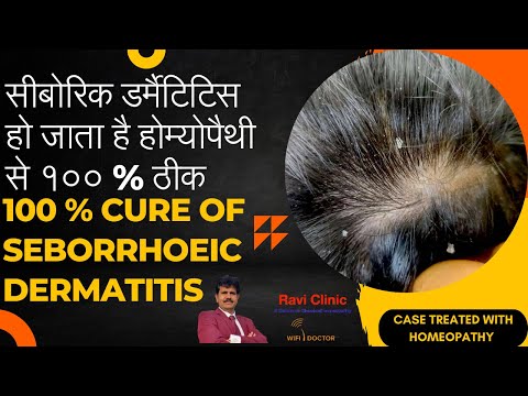 How I Overcame One Year of Seborrhoeic Dermatitis Using Homeopathy