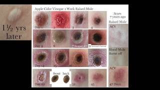 Q & A Mole vs Apple Cider Vinegar & Scars 1.5 Years Later
