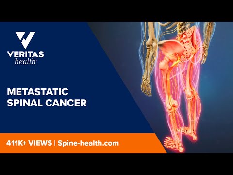 Metastatic Spinal Cancer