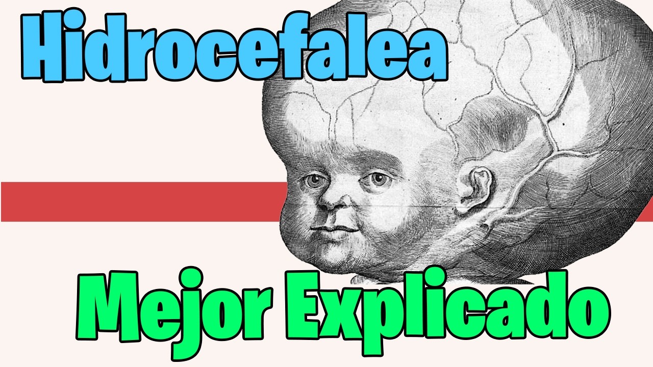 HIDROCEFALIA Que es ? CAUSAS, SINTOMAS , DIAGNOSTICO Y TRATAMIENTO