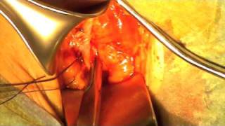 Crossotomia safeno femorale in anestesia locale - chiva varici vene varicose veneinforma