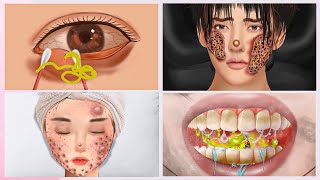 ASMR Series: Pimple Extraction & Dermatitis Treatment | Deep Cleansing Animation