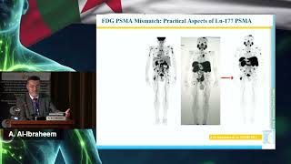 AICONM24 - PSMA Radioligand Therapy INmCRCP (A. AL IBRAHEEM)