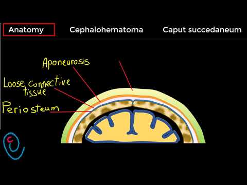 Cephalohematoma versus Caput succedaneum