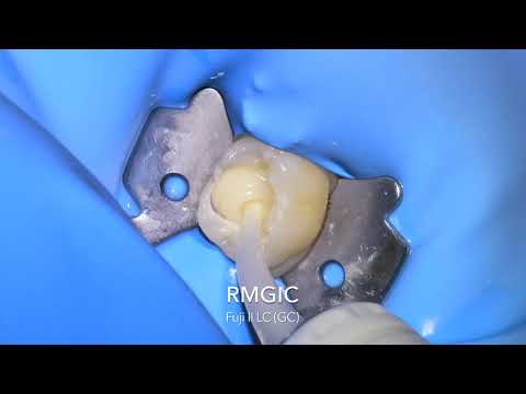 Primary molar pulpotomy and ssc