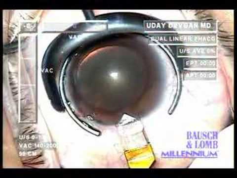 Cataract Surgery - Corneal Incision