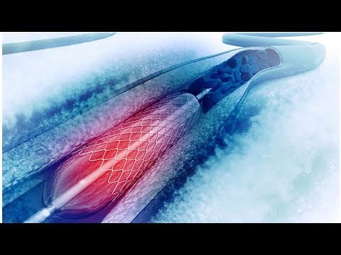 Dolore alla fronte con osteocondrosi Foglia di alloro sciolto il sale in osteocondrosi
