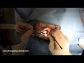 SurgeonCam How to fix a broken nose and deviated septum