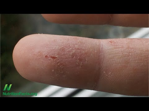 Se è possibile trattare sanguisughe di psoriasi Standard di eczema di assistenza