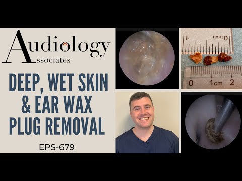DEEP, WET SKIN & EAR WAX PLUG REMOVAL - EP 679