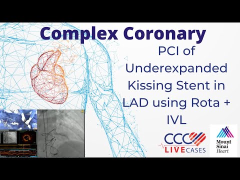 PCI of Underexpanded Kissing Stent in LAD using Rota + IVL