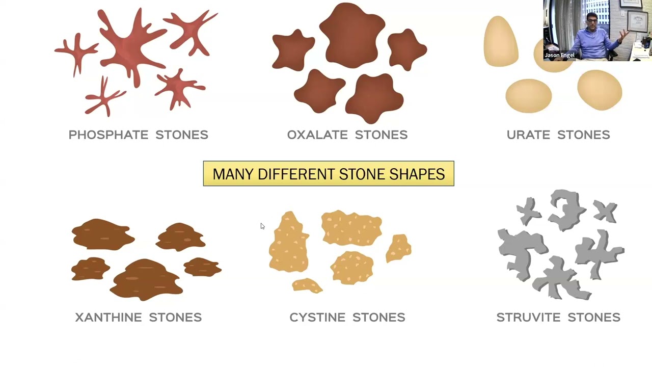 Kidney Stone Webinar Presented by Dr. Jason Engel