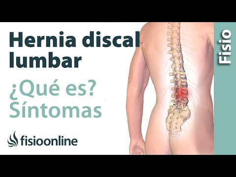 Hernia discal o de disco lumbar - Qué es, causas, síntomas y tratamiento