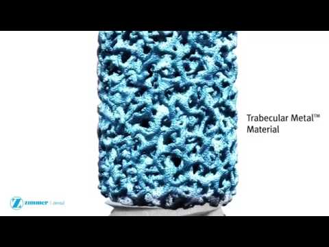 Zimmer Trabecular Metal Dental Implant