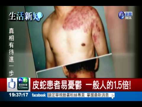 皮蛇上身易憂鬱 一般人的1.5倍!