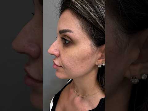 Nose Filler Treatment