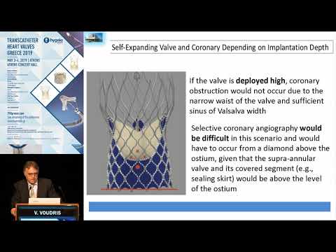 V. Voudris | A growing conundrum: Coronary access after TAVR. Difficulties, tips and tricks
