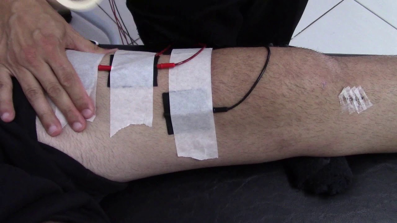 Eletroestimulação Muscular Quadríceps CIRURGIA JOELHO LCA e MENISCO - Fisioterapia Dr. Robson Sitta