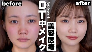 【ベースメイク】美容医療後のダウンタイムをカバーする日のメイク