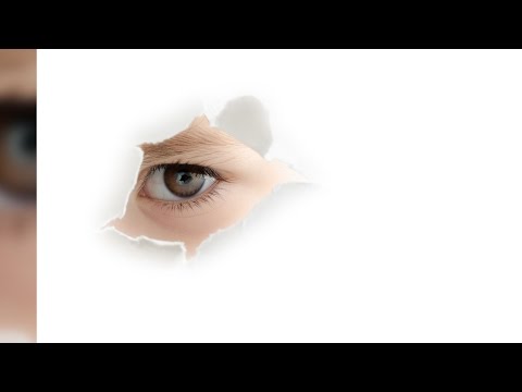 눈 주변에 생긴 좁쌀종(비립종), 쉽게 없앨 수 있다