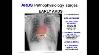 Dr Manny VV ECMO Learnshop part 3: ARDS pathophsiology
