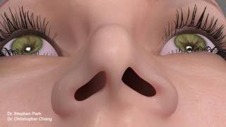 Pinched Narrow Nose Rhinoplasty to Address Nasal Obstruction
