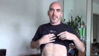 Laparoscopic Cholecystectomy GallBladder Surgery pre and post op 25MAR11 scars