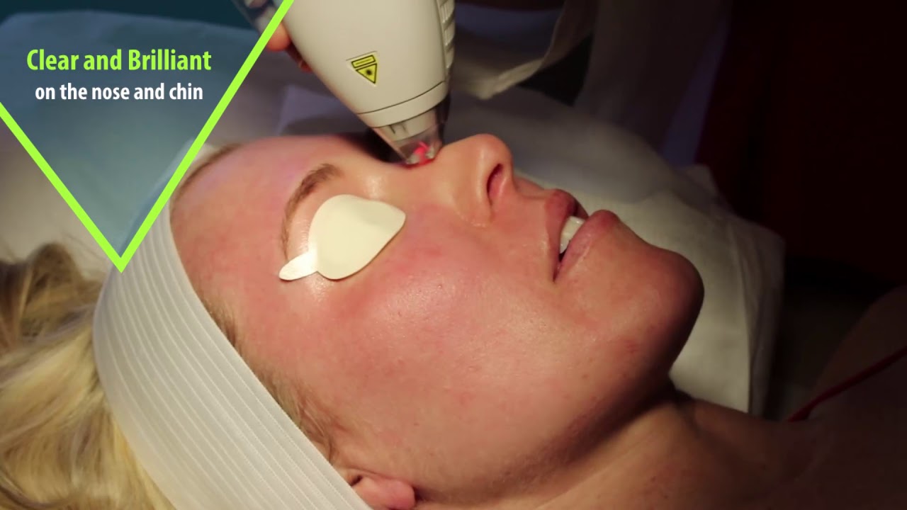 Clear and Brilliant treatment - Proactive Laser Skin Care - Encinitas CA