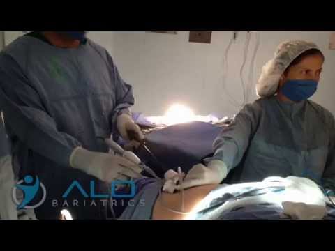 Single Incision Gastric Sleeve - Procedure Video | ALO Bariatrics Tijuana