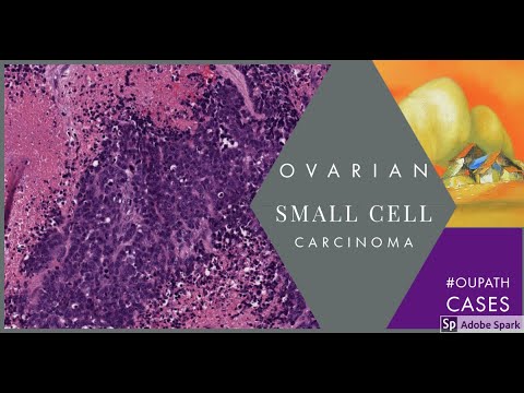 Digital Surgical Pathology 43 Small cell carcinoma of the ovary
