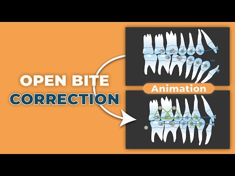 Got a Case with Open Bite? TRY THIS - Effective Orthodontic Tools #TADs  - @csorthoschool