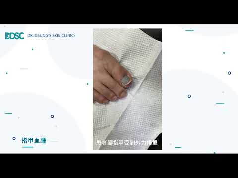 腳指甲黑垢