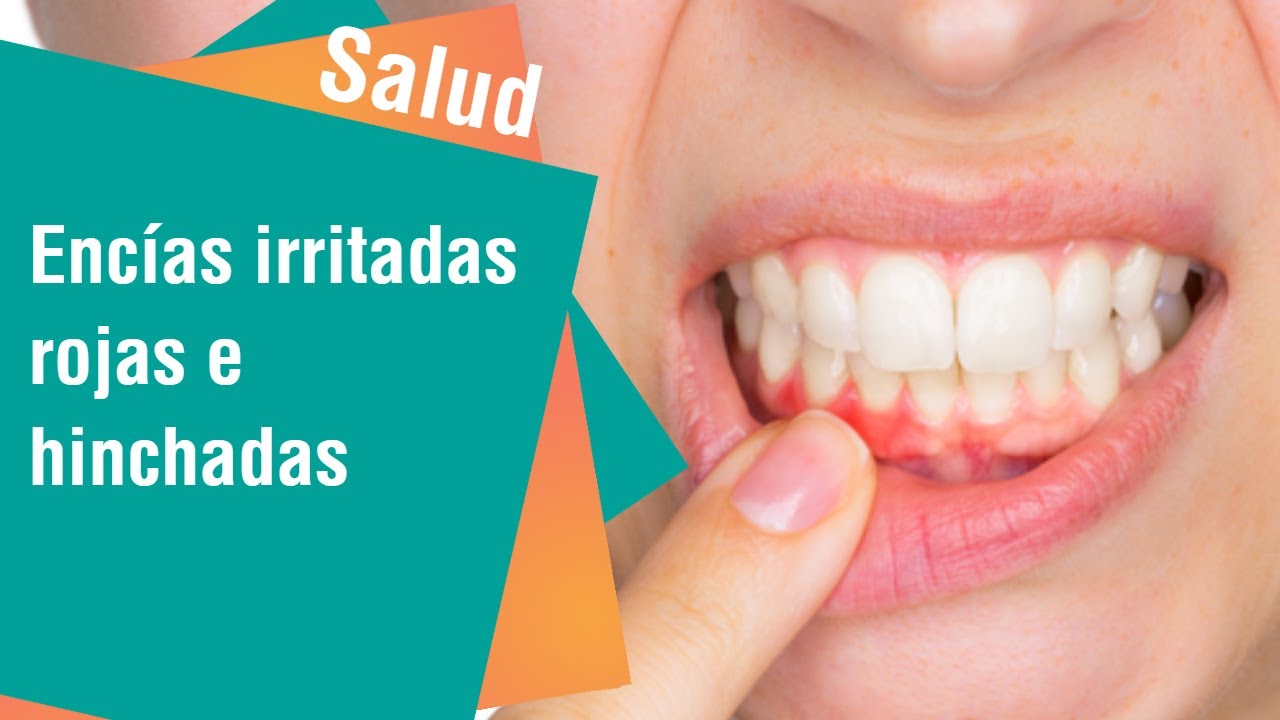 Watch Evite las encĆas irritadas, rojas e hinchadas | Salud Now Evite las encĆas irritadas, rojas e hinchadas | Salud