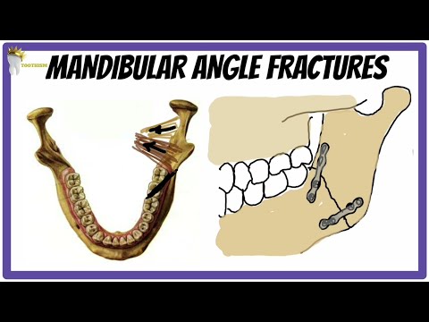 MANDIBULAR ANGLE FRACTURES | Clinical features, treatment options