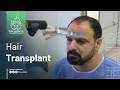 Hair Transplant In Turkey Details And Results Before And After