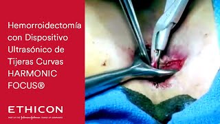 Hemorroidectomía con Dispositivo Ultrasónico de Tijeras Curvas HARMONIC FOCUS