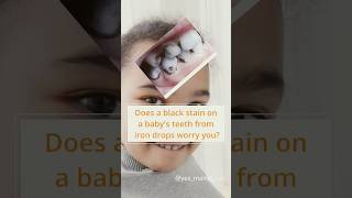 Black stain on baby teeth   #kids #reels