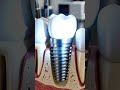 No Screws, No Pain?! The Future of Dental Implants 🔥 | Screwless Implants Explained 😱 #shorts