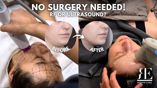 RF vs. Ultrasound Lifting: Which Is Better for YOU? 🤔 | Thermage FLX, Ultherapy, V-Lift & More
