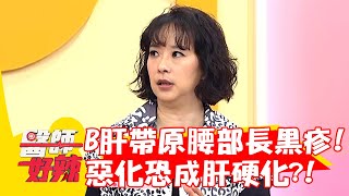 李祖寧父B肝帶原腰部長「黑疹」！惡化恐成「肝硬化」？！【#醫師好辣】20221206 part3 EP1461 陳榮堅 李祖寧