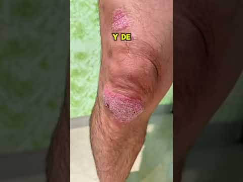 Testimonio de paciente