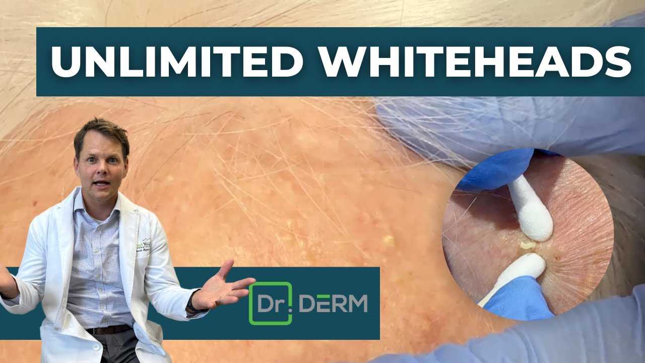 Unlimited Whiteheads! | Dr. Derm