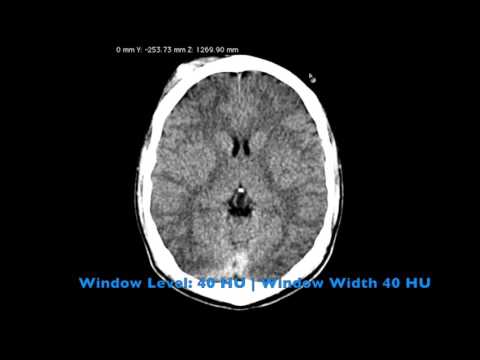 CT Scan of the Head: A Radiologist's Approach