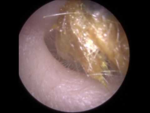 Ear Wax Removed from very Narrow and Twisted Ear Canal - Mr Neel Raithatha (THC)