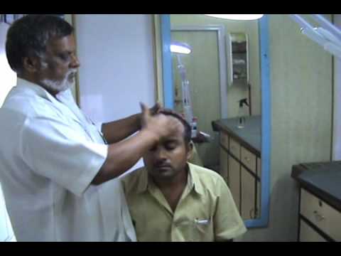 MTB BALDNESS TREATMENT WITH INDIAN PLANT PART 1