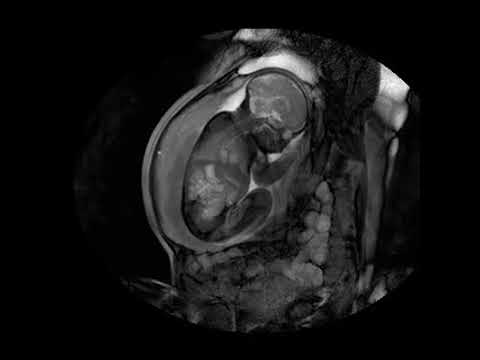 MRI scan at 32 weeks