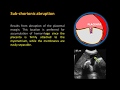 Ultrasound Imaging of Placental Abruption