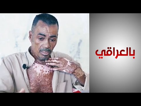 شاهد بالفيديو.. قصة مواطن يعاني من عسر الحال وسوء أحواله الصحية